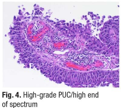 Fig. 4. High-grade PUC/high end of spectrum