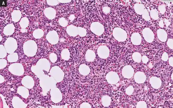 Bone marrow biopsy