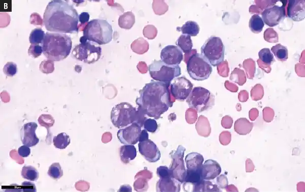 bone marrow aspirate
