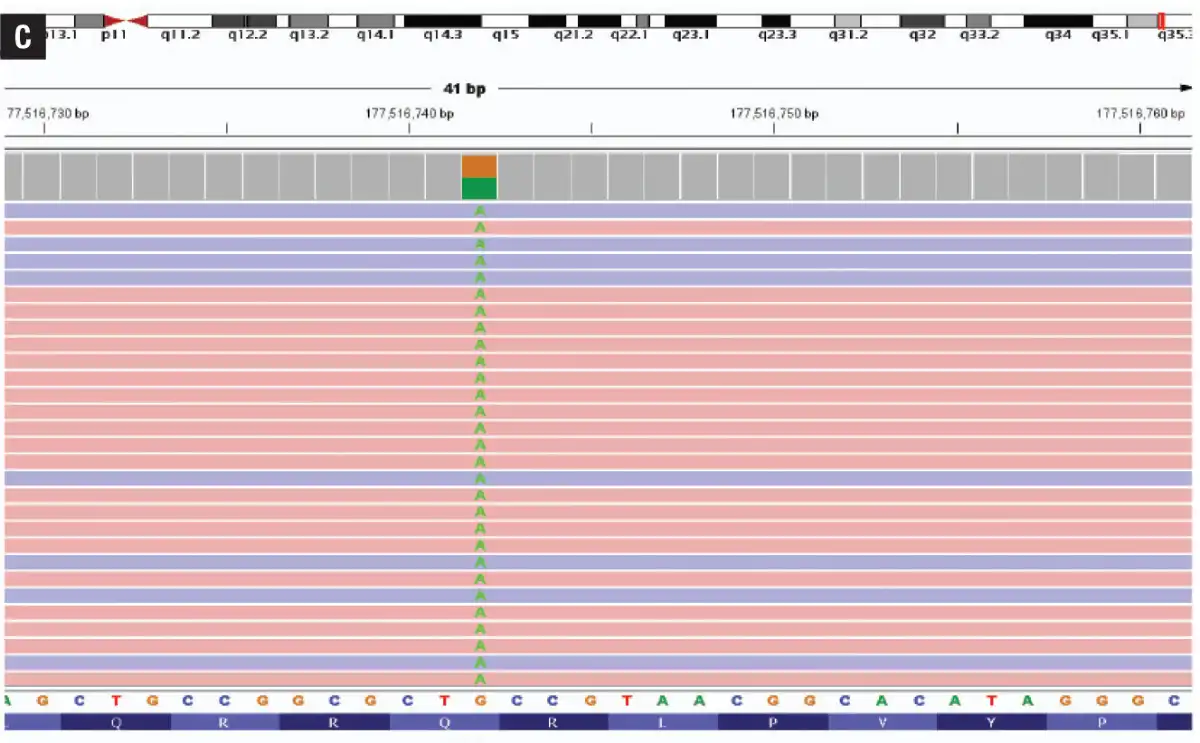 Integrative Genomics Viewer (IGV) demonstrates the DDX41 p.Q41* variant