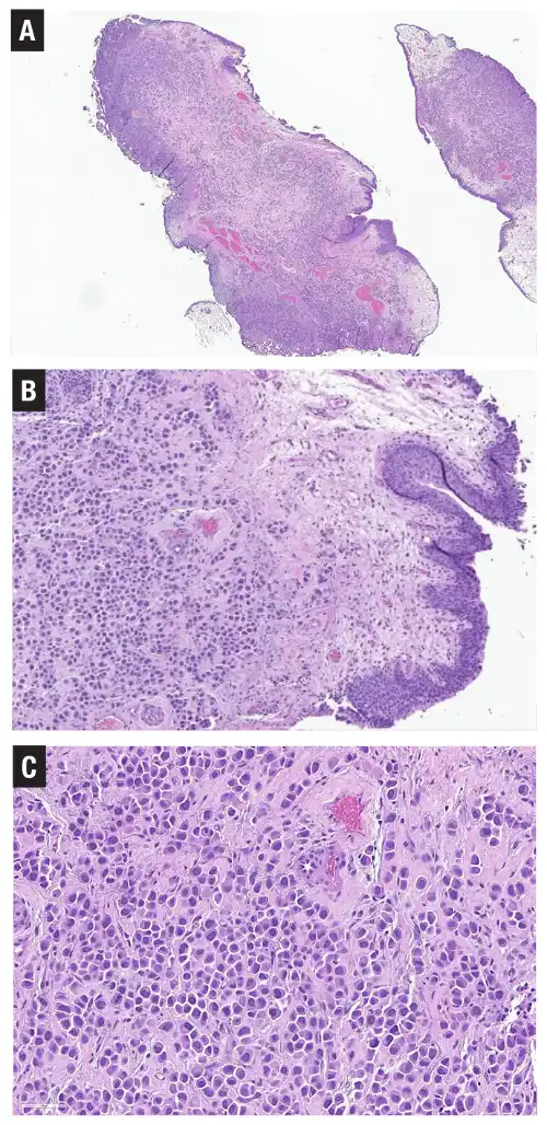 Urothelial carcinoma: histologic subtypes and divergent differentiation