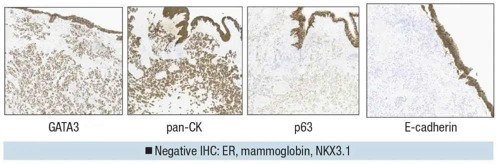 Urothelial carcinoma: histologic subtypes and divergent differentiation