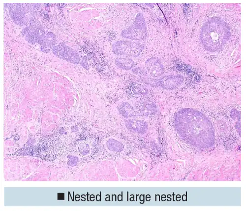 Urothelial carcinoma: histologic subtypes and divergent differentiation