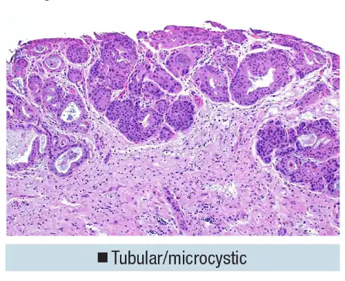 Urothelial carcinoma: histologic subtypes and divergent differentiation