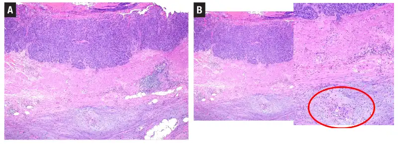 Urothelial carcinoma: histologic subtypes and divergent differentiation