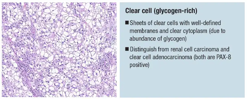 Urothelial carcinoma: histologic subtypes and divergent differentiation