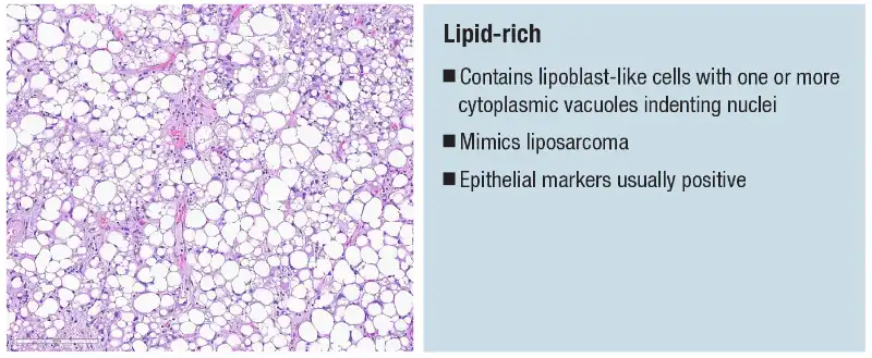 Urothelial carcinoma: histologic subtypes and divergent differentiation