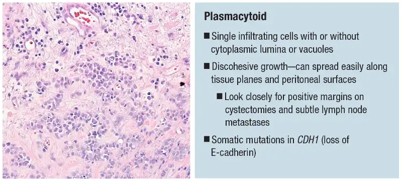 Urothelial carcinoma: histologic subtypes and divergent differentiation