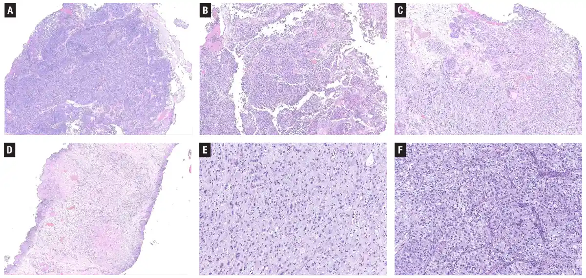 Urothelial carcinoma: histologic subtypes and divergent differentiation
