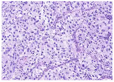 Urothelial carcinoma: histologic subtypes and divergent differentiation
