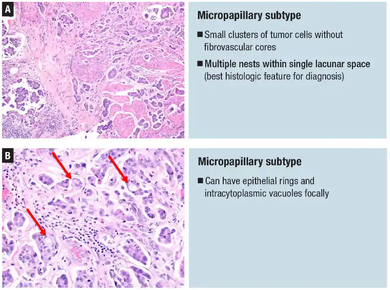 Urothelial carcinoma: histologic subtypes and divergent differentiation
