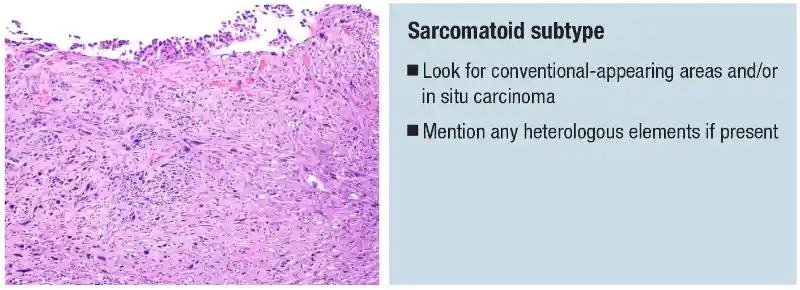 Urothelial carcinoma: histologic subtypes and divergent differentiation