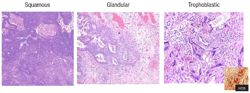 Urothelial carcinoma: histologic subtypes and divergent differentiation