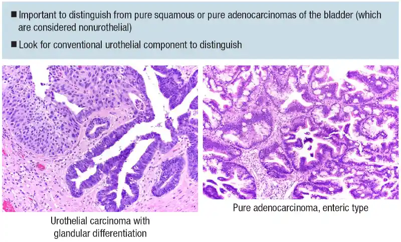 Urothelial carcinoma: histologic subtypes and divergent differentiation