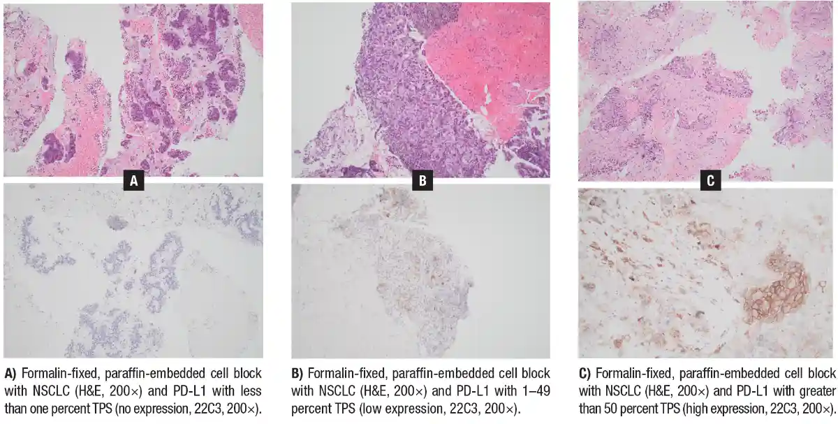 Levels of PD-L1 expression in cytology cell blocks