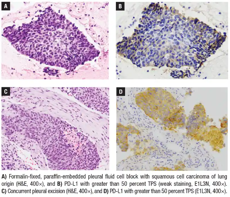 Concordant staining between concurrent cytology and surgical biopsy specimens