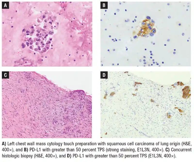 Concordant staining between paired cytology touch preparation and surgical biopsy specimens
