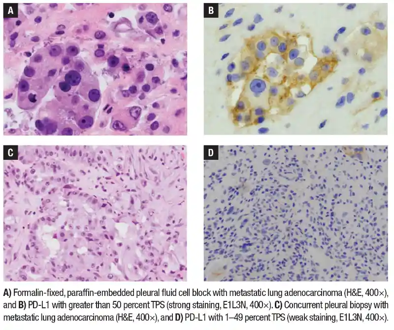 Discordant staining between concurrent cytology and surgical biopsy specimens