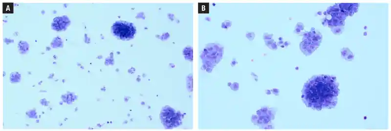 Cytospin from CSF sample