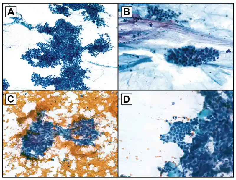 Representative salivary gland fine-needle aspiration specimens sent for fusion assay