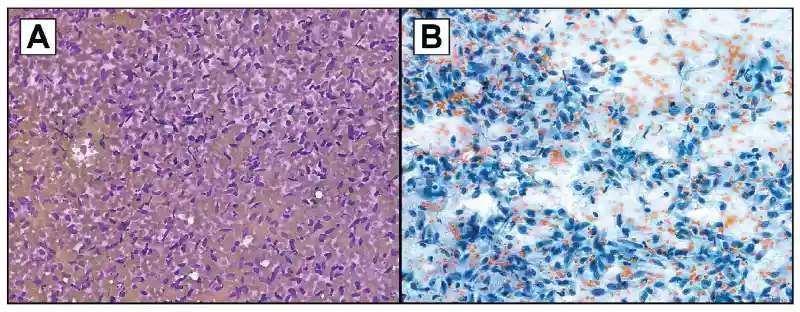 Representative soft tissue fine-needle aspiration specimens sent for fusion assay