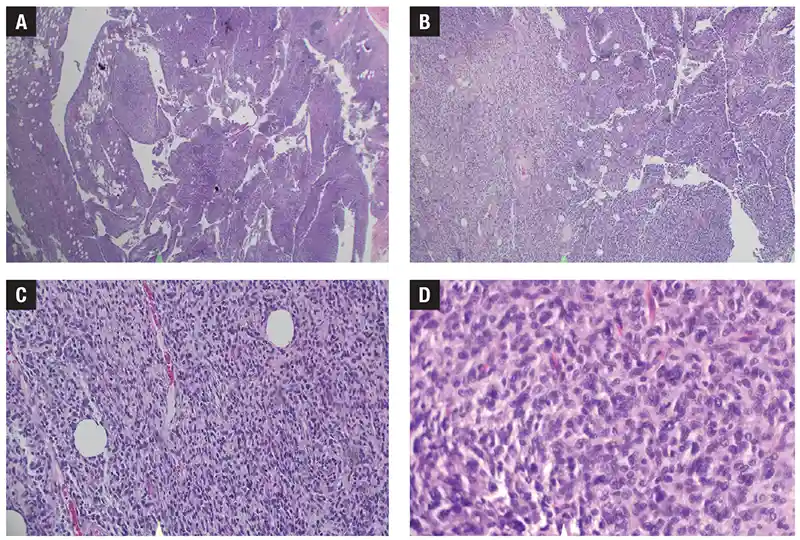 Undifferentiated sarcoma with EWSR1-POU5F1 fusion.