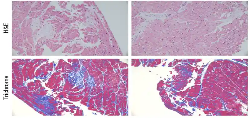 Endomyocardial biopsy—patient with MGUS