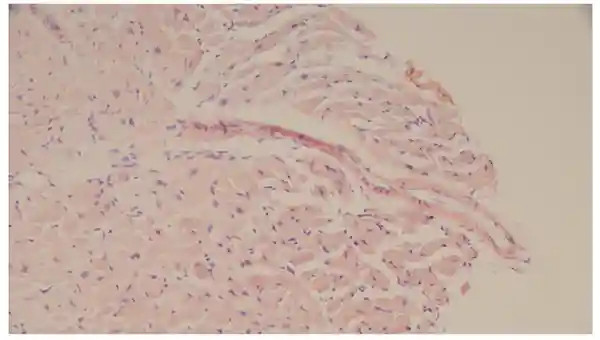 Endomyocardial biopsy (Congo red)—subtle