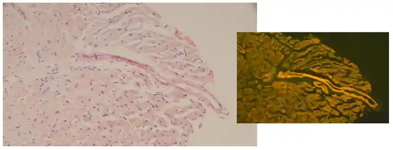 Endomyocardial biopsy (Congo red)—TRITC