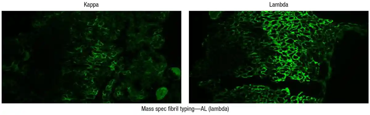 Endomyocardial biopsy—immunofluorescence
