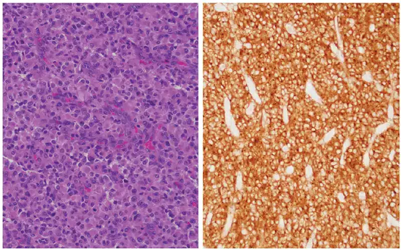High-grade diffusely infiltrating glioma