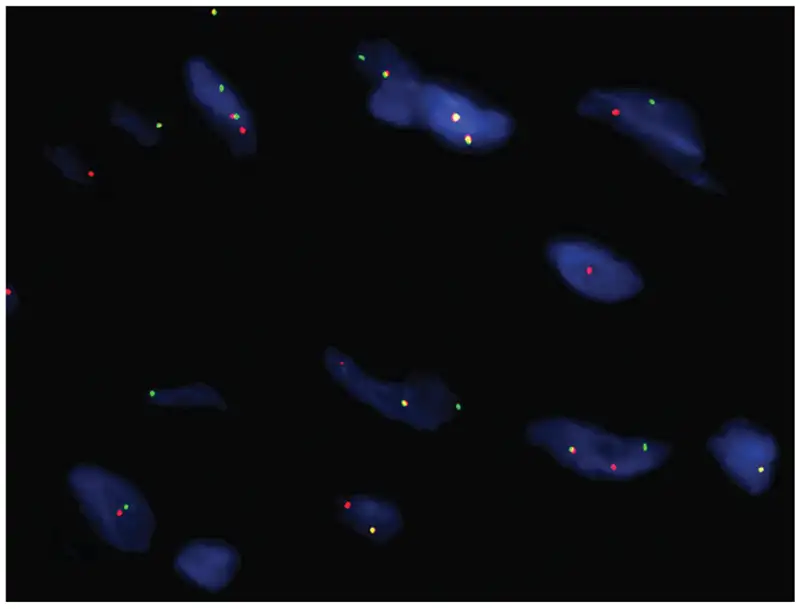Fluorescent in situ hybridization using ALK (2p23) break-apart probe